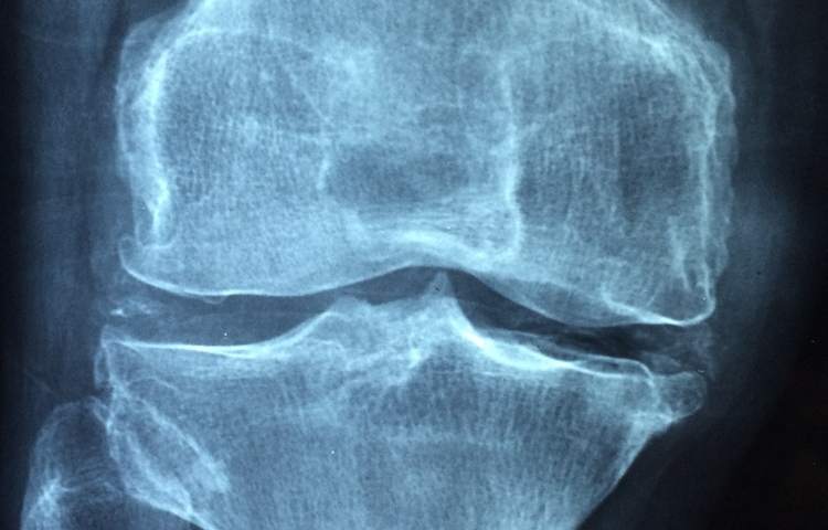 Scopri quale cibo può aiutarti a combattere l'osteoporosi